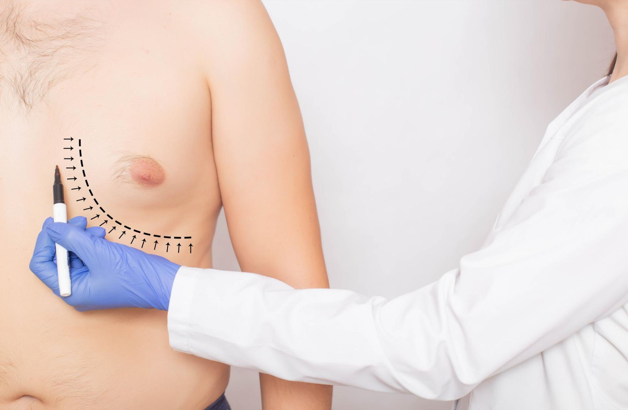 Gynecomastia treatment