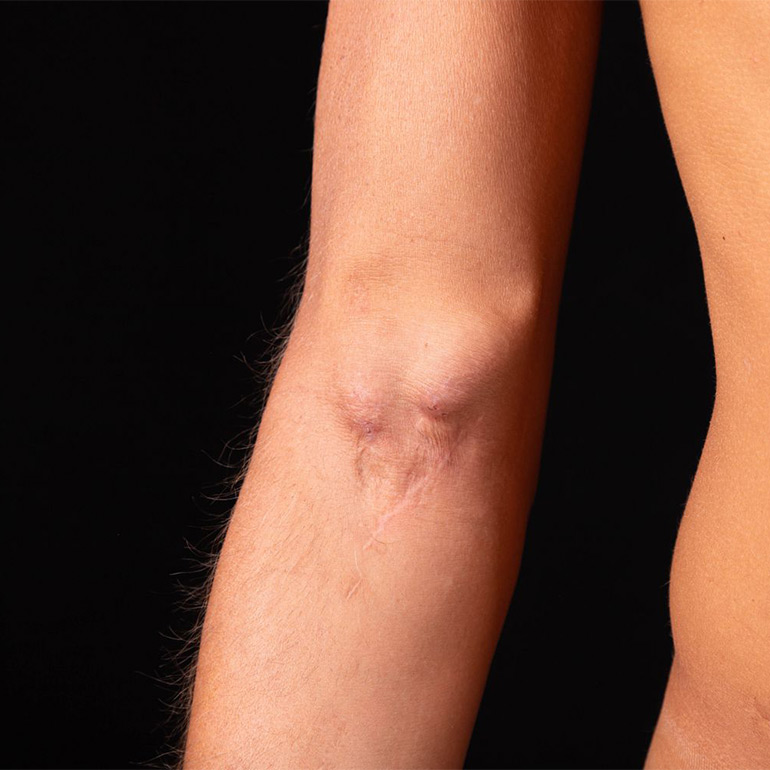 AV Fistula Surgery