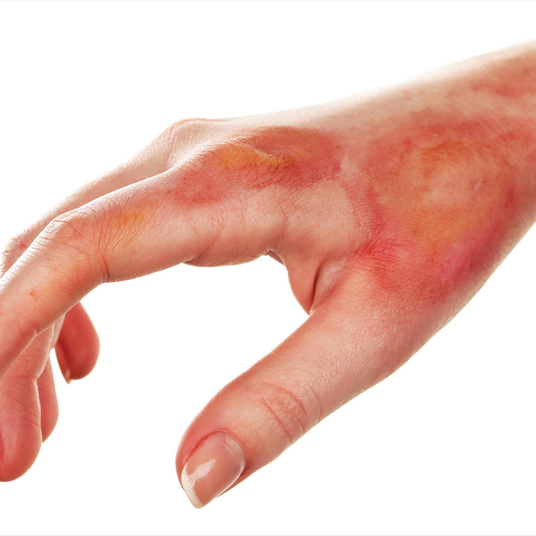 Acute Burn Care