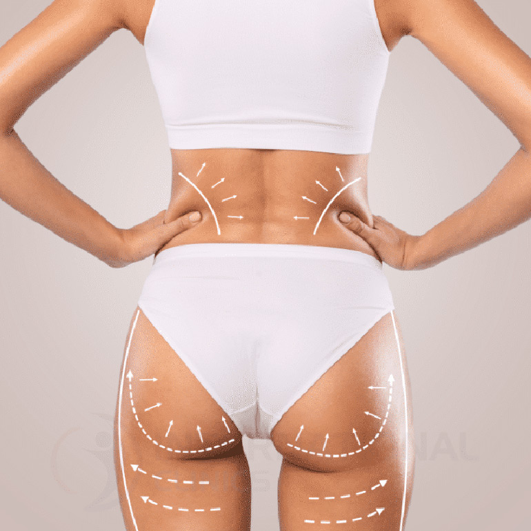 Back Liposuction