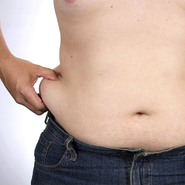 Belly Fat Liposuction