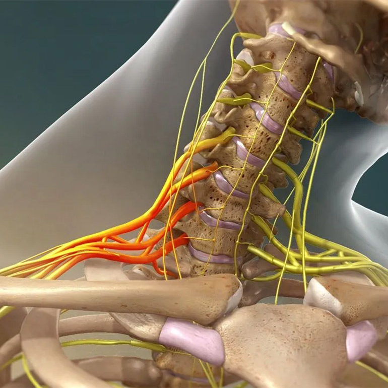 Brachial Plexus Surgery