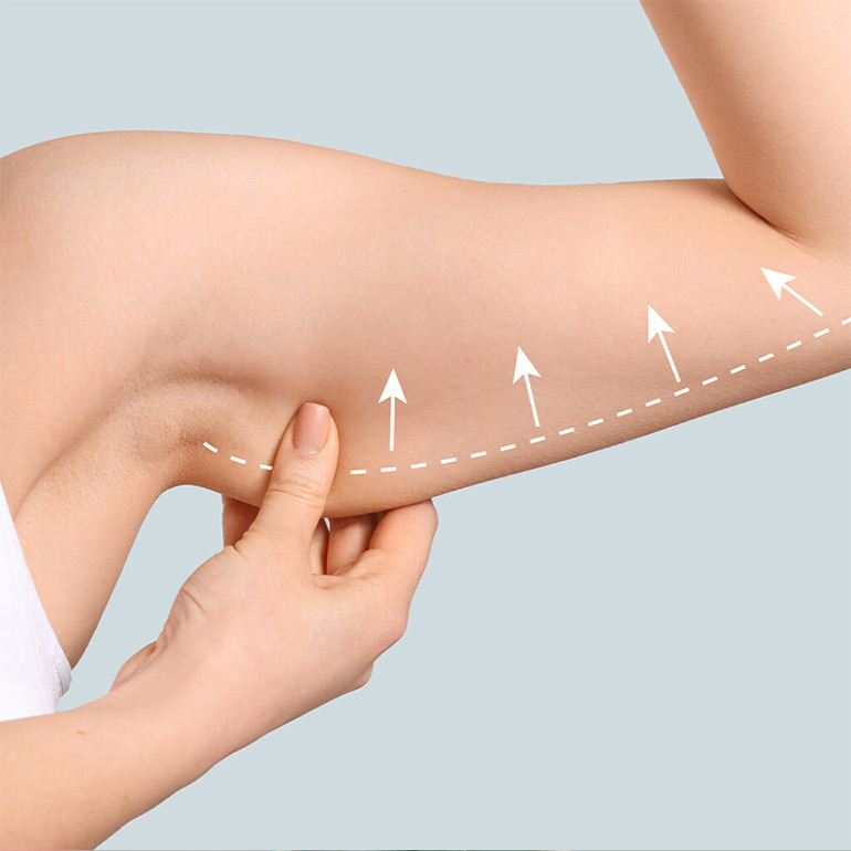Brachioplasty procedure