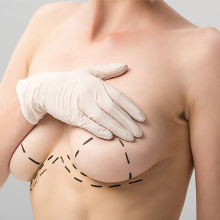 Breast Lift