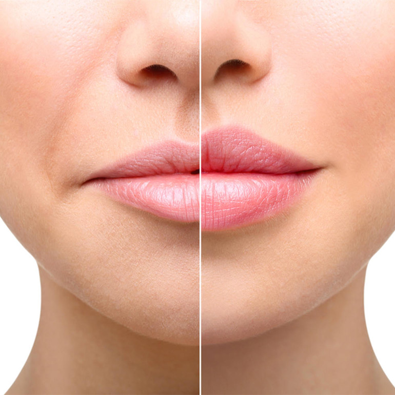 Cheiloplasty before and after