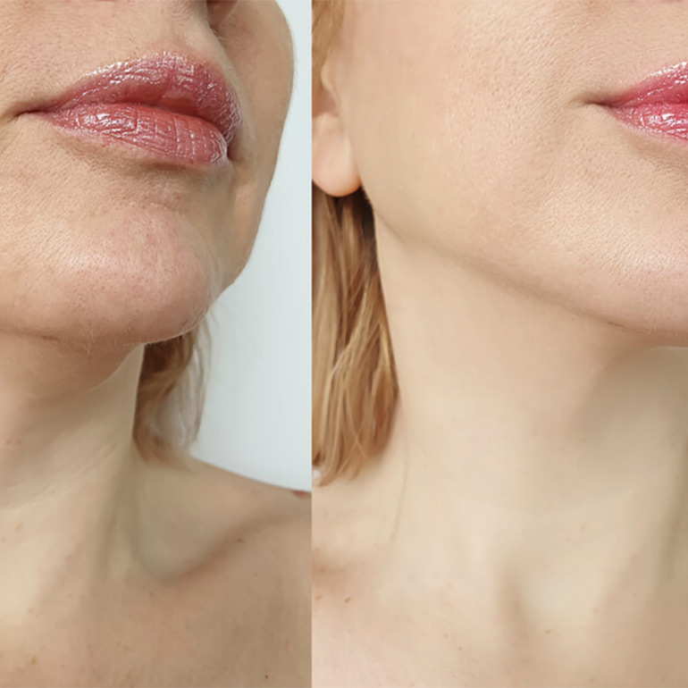 Chin Liposuction