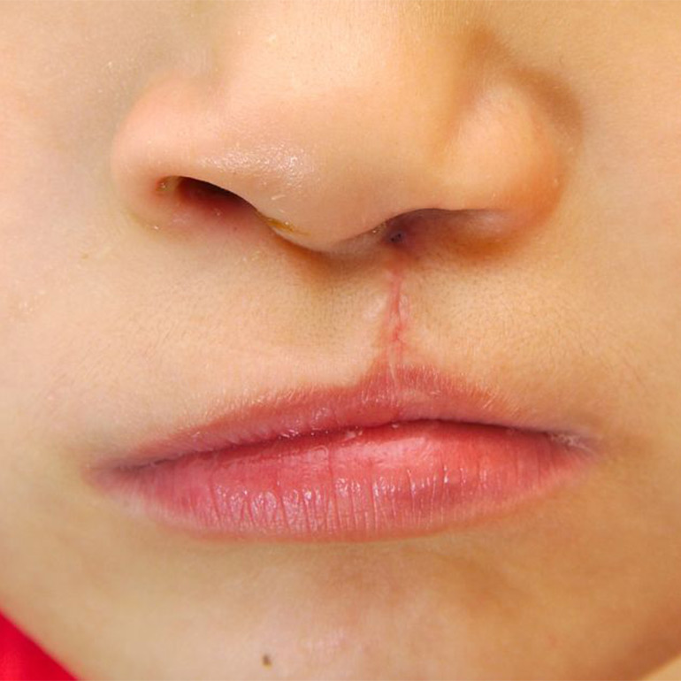 Cleft Lip and Palate Surgery
