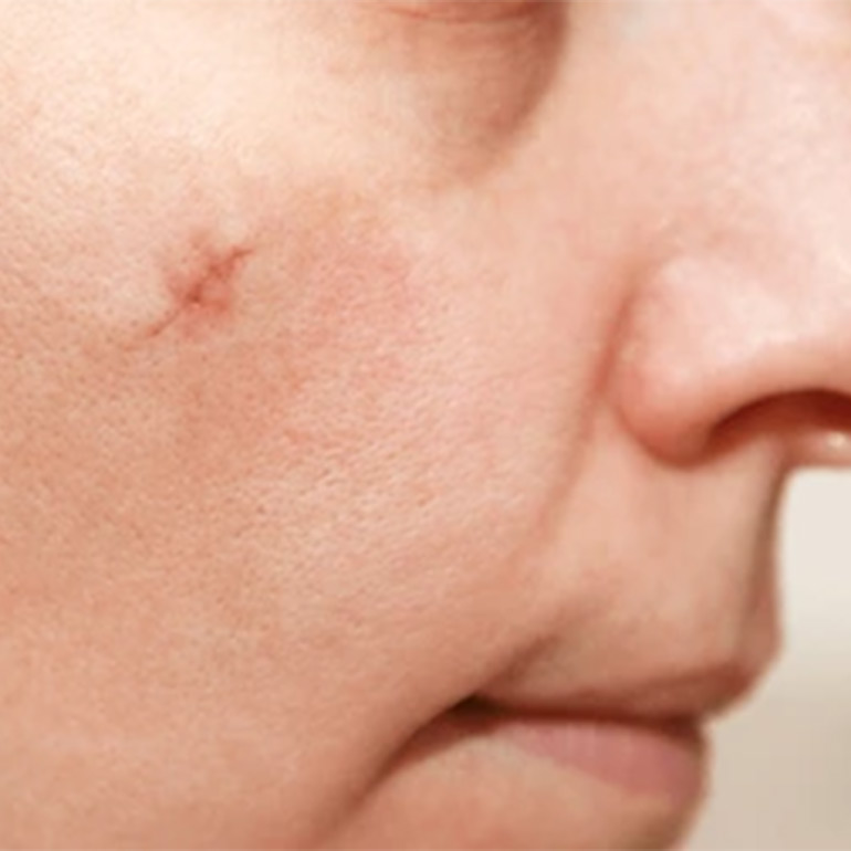 Cosmetic Suturing