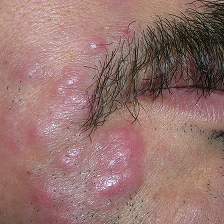 Facial Cancer Reconstruction