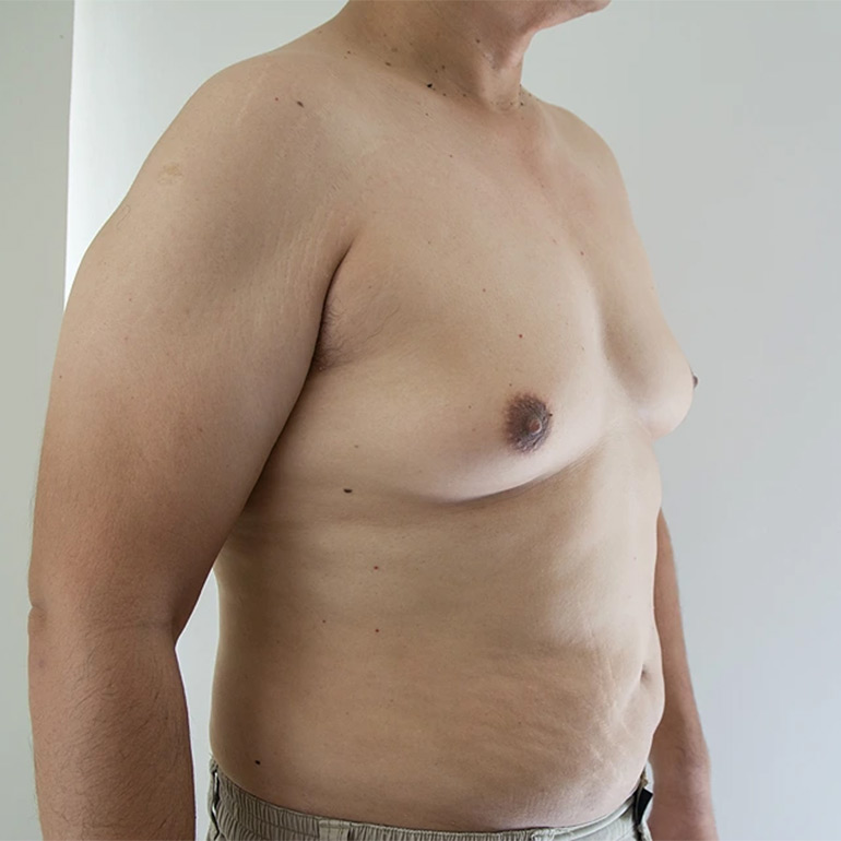 Gynecomastia