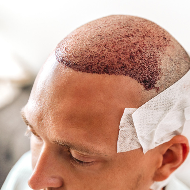 Hair Transplant