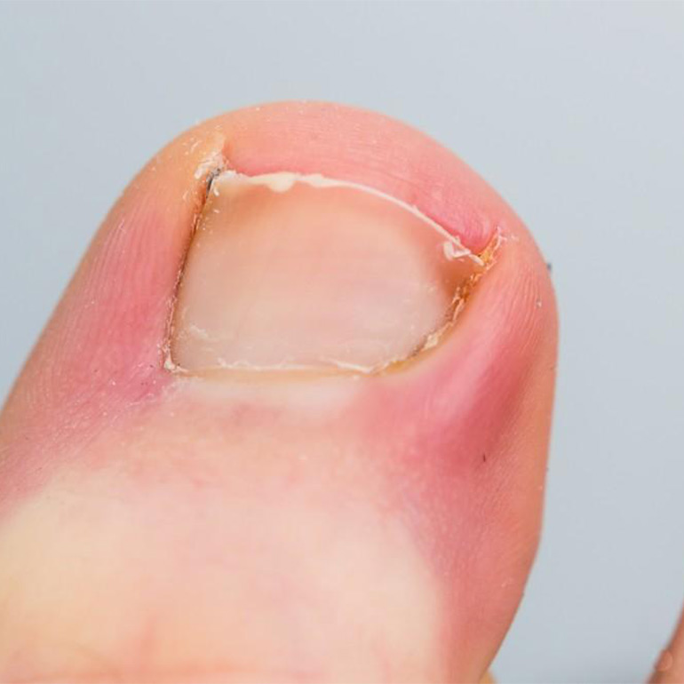 Ingrown Toenail