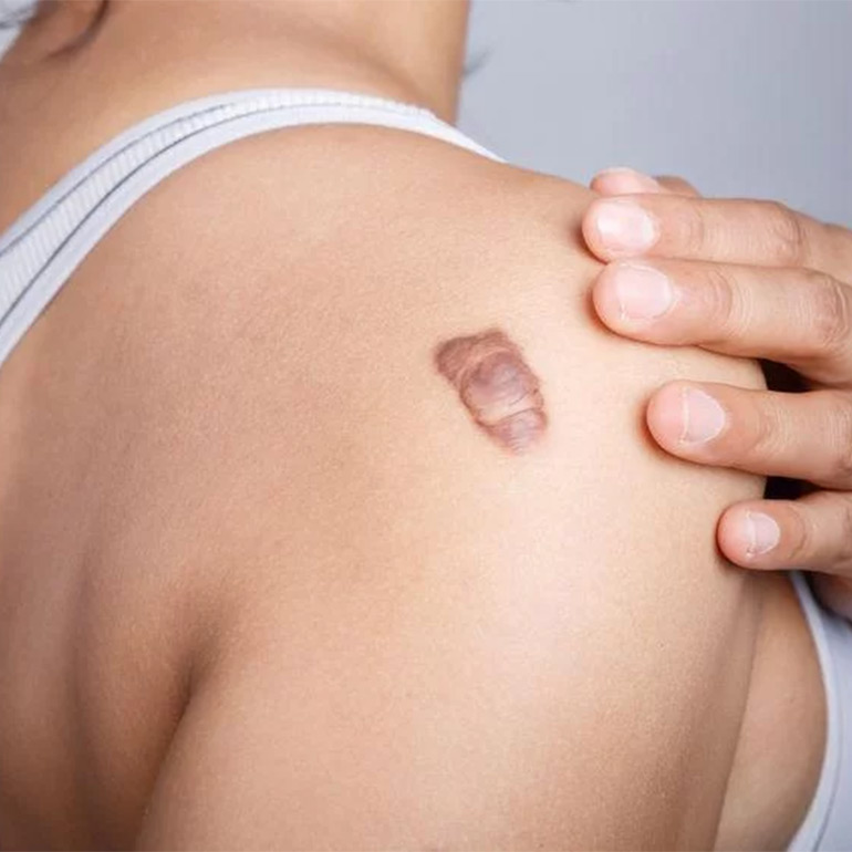 Keloid Treatment