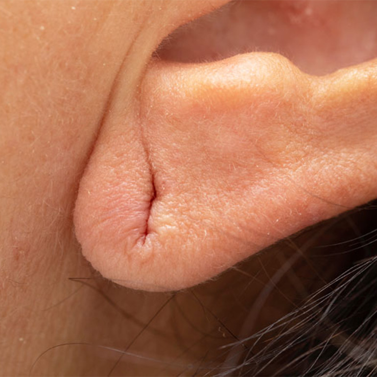 Lax Ear-Lobe Repair