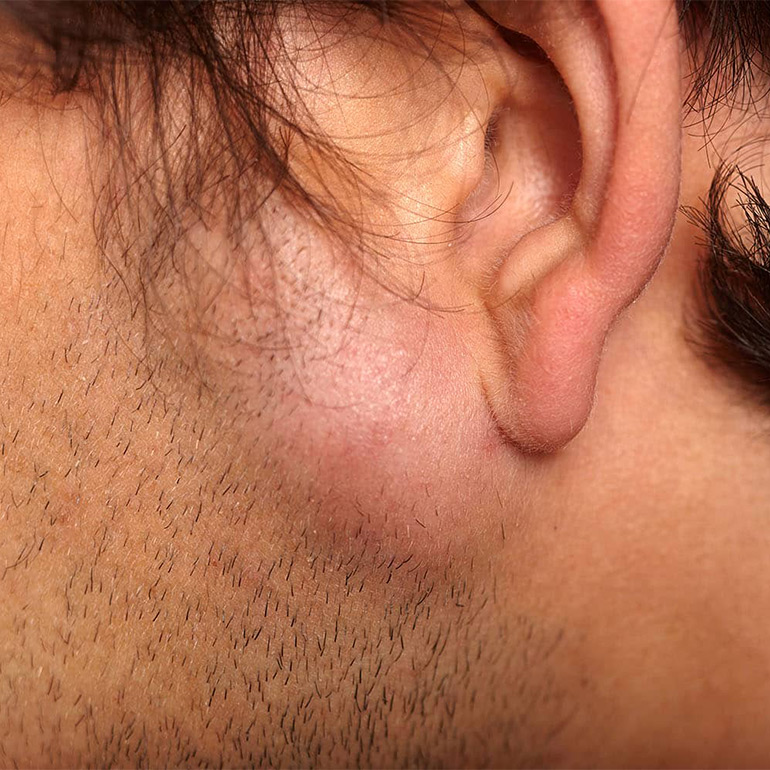Lipoma/Cyst Removal