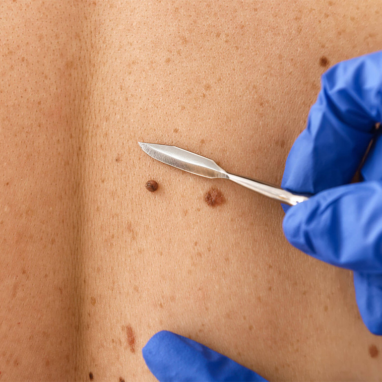 Mole Removal
