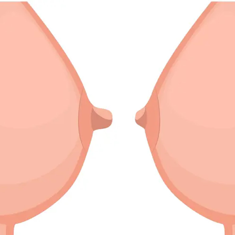 Nipple Reduction