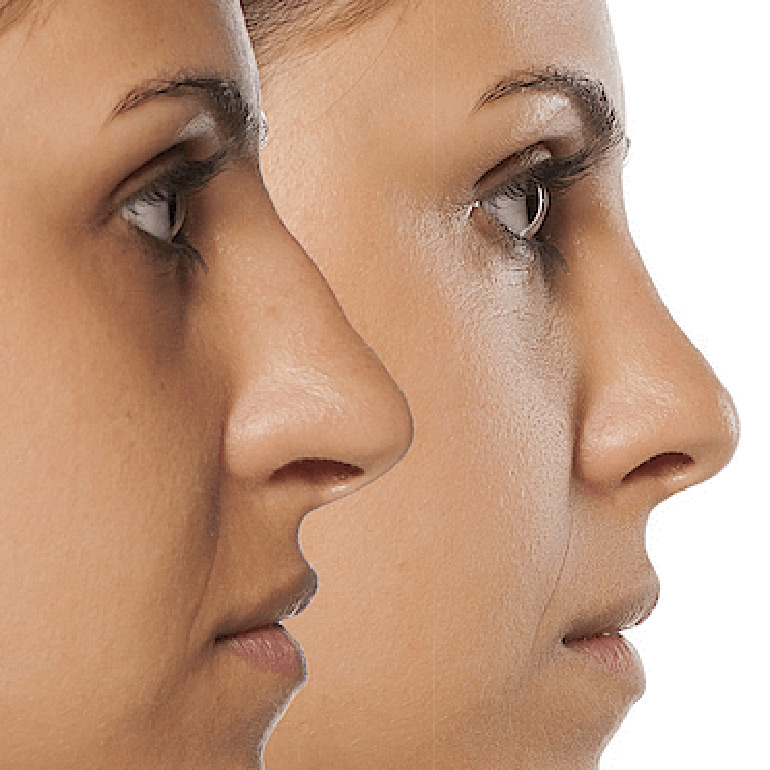 Rhinoplasty
