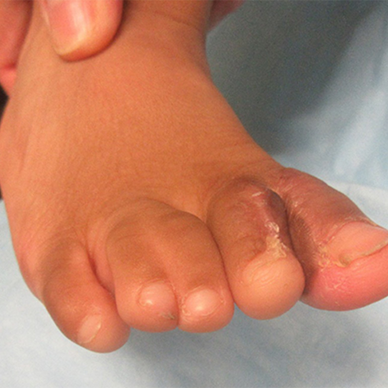 Syndactyly Surgery