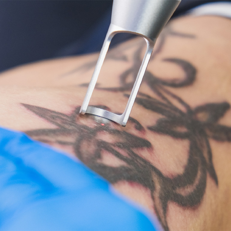 Tattoo Removal