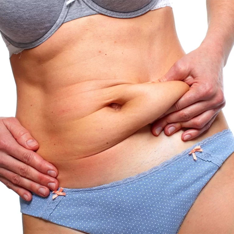 Tummy Tuck