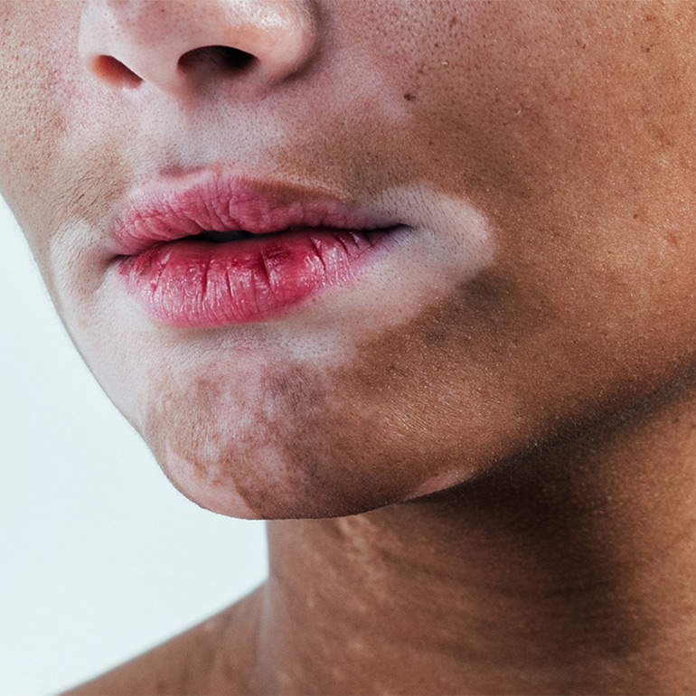 Vitiligo Surgery