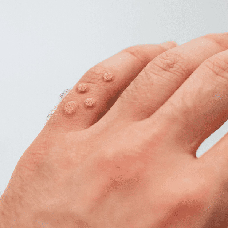 Wart Removal