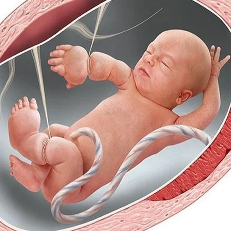 Amniotic Band Syndrome Surgery