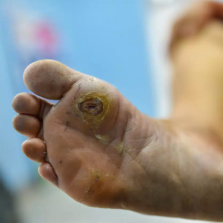 Diabetic Foot Care