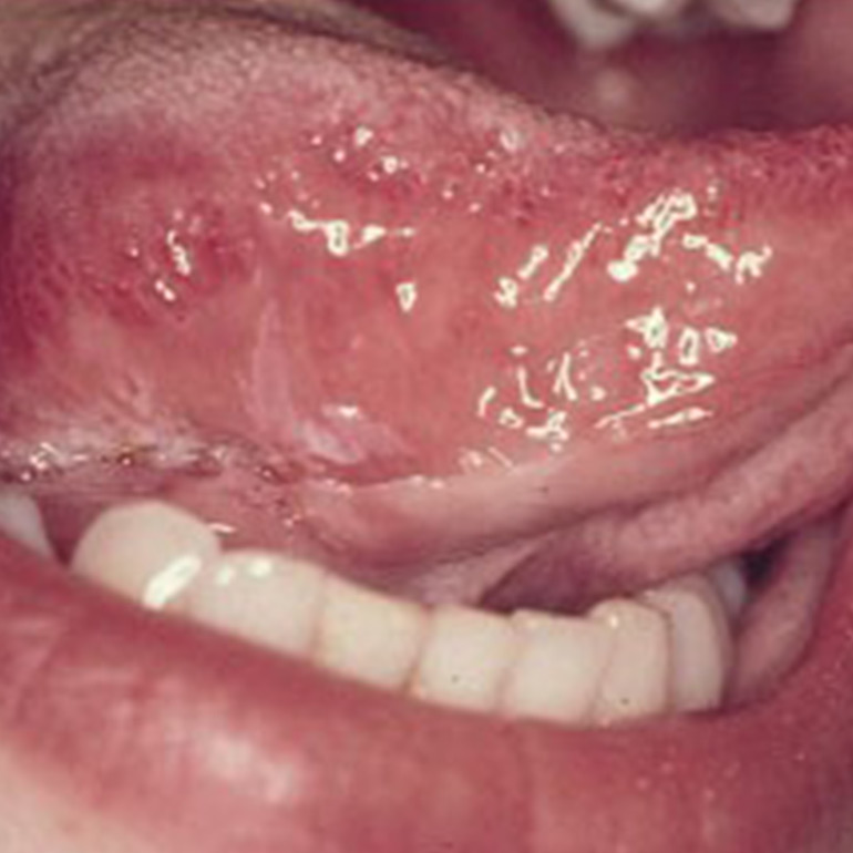 Oral Cavity Reconstruction
