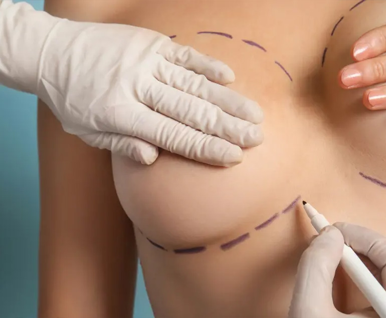 Breast Reduction procedure