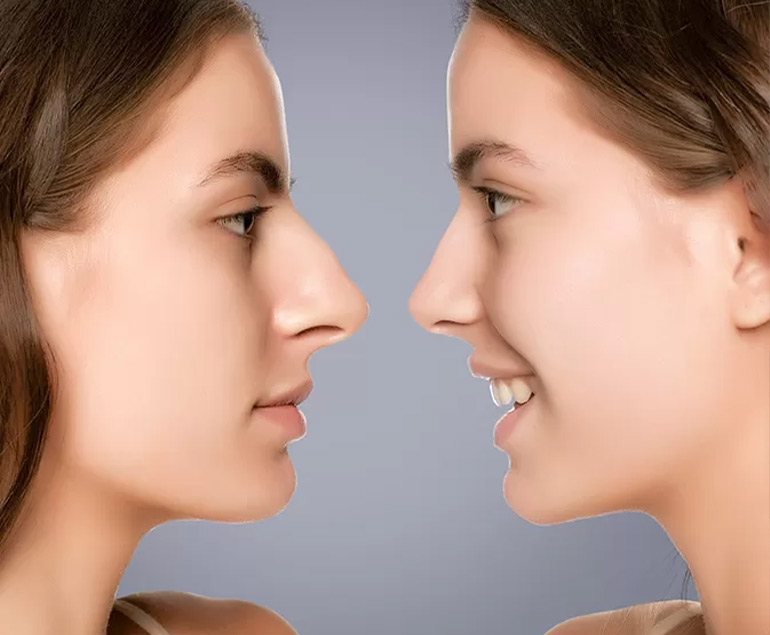 Rhinoplasty before and after