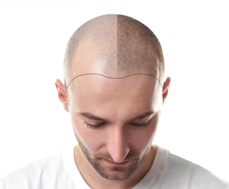 Hair transplant before and after